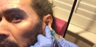 Russell Brand Cauliflower Ear drain