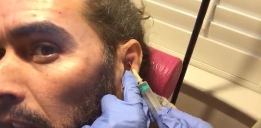 Russell Brand Cauliflower Ear drain