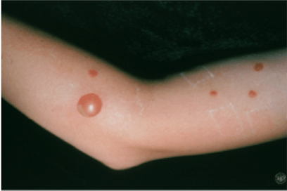 BJJ Skin Infections Impetigo