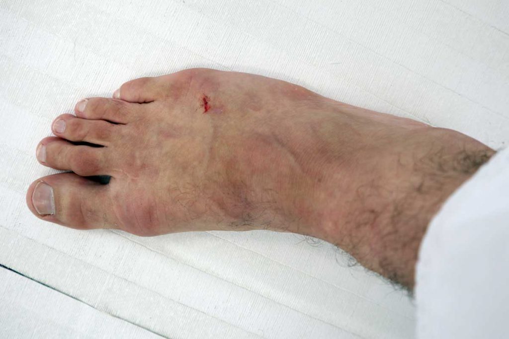 Common BJJ Skin Infections Psoriasis, Impetigo and Herpes BJJ World