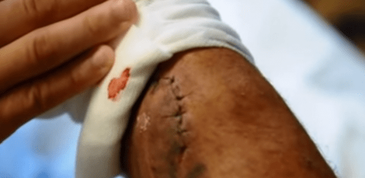 BJJ Staph Infection : Everything about