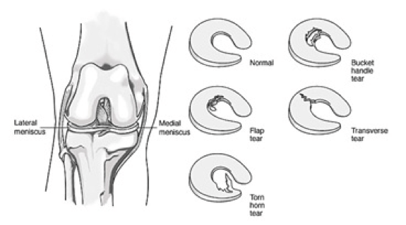 BJJ knee injury meniscus tear