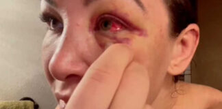 Miesha Tate Removes Her Own Stiches and Shares a Video of Doing It