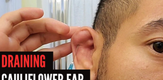 Step-by-Step DIY Guide To Drain Cauliflower Ear On Your Own