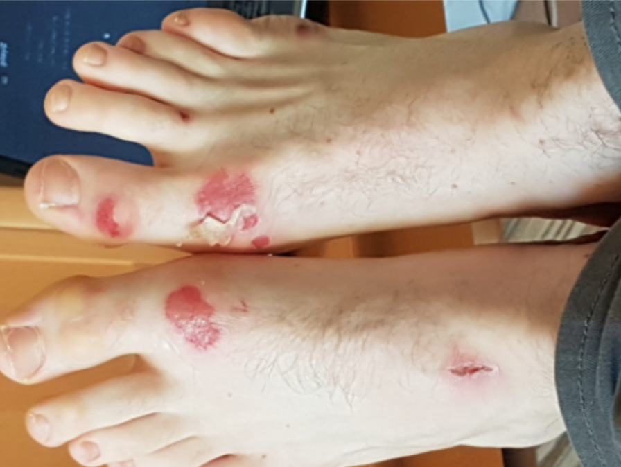 Feet mat burns from competing in Brazilian Jiu-Jitsu
