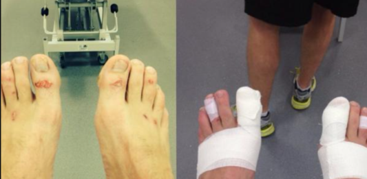 Mat Burn In BJJ: What It Is, How To Prevent It, And How To Treat It