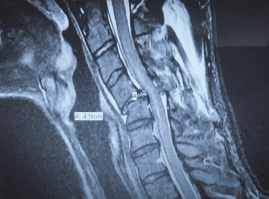 BJJ Injury Lawsuit After Catastrophic Neck Break